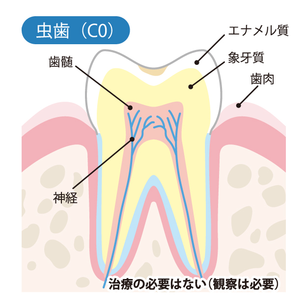 四国中央市の歯医者、今村歯科医院で虫歯治療